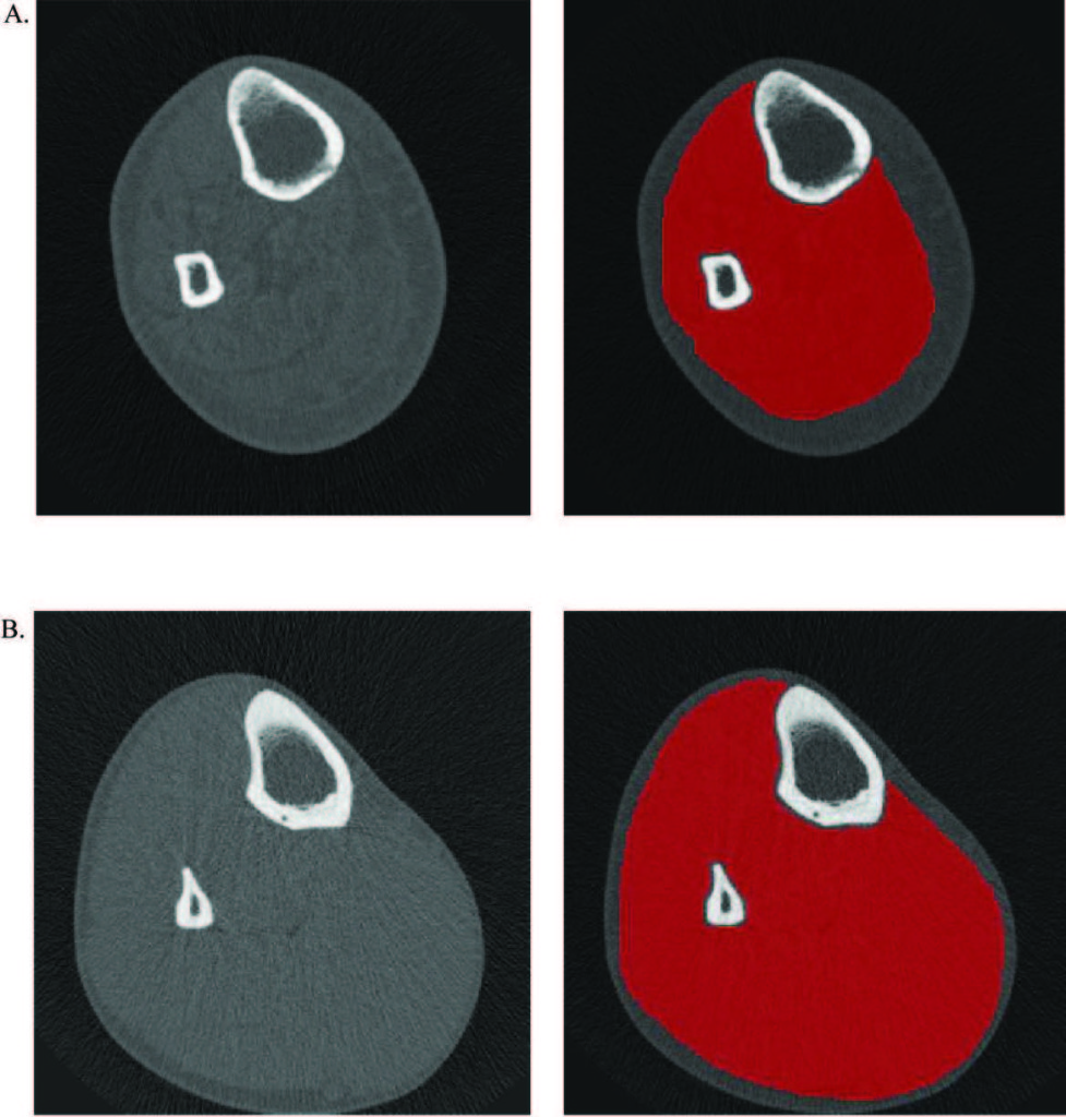 An illustration of watershed-guided muscle segmentation of the 66% site of the calf of a male with complete paraplegia (A) and corresponding able-bodied control (B).